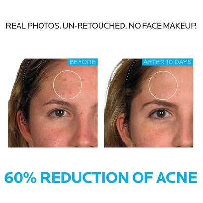 La Roche-Posay Effaclar Dermatological 3 Step Acne Treatment System, Salicylic Acid Acne Cleanser, Pore Refining Toner, and Benzoyl Peroxide Spot Treatment for Sensitive Skin
