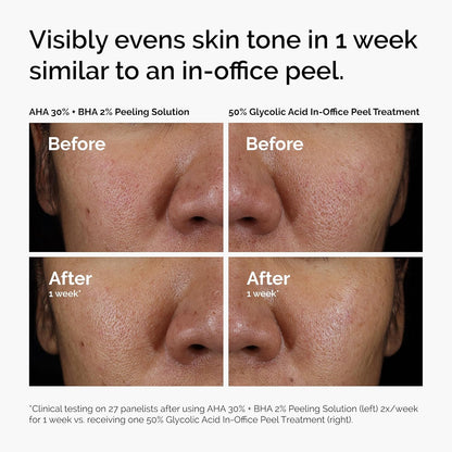 The Ordinary AHA 30% + BHA 2% Peeling Solution, Advanced Exfoliating Peel for Brighter Skin